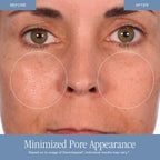 DermAppeal® Microdermabrasion Treatment-Shop